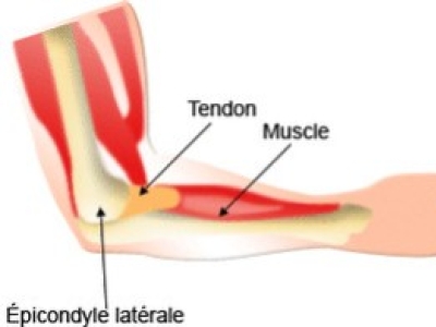 Douleurs et blessures au bras : les solutions